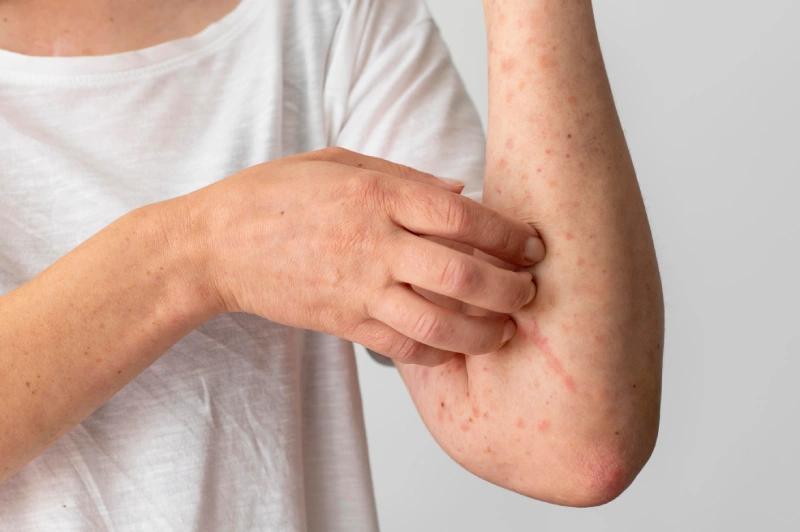 seasonal illnesses skin rash