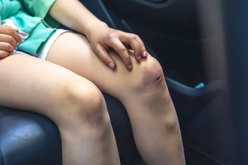 Close-up of girl holding her injured bruised knee with hands, screwworm infection